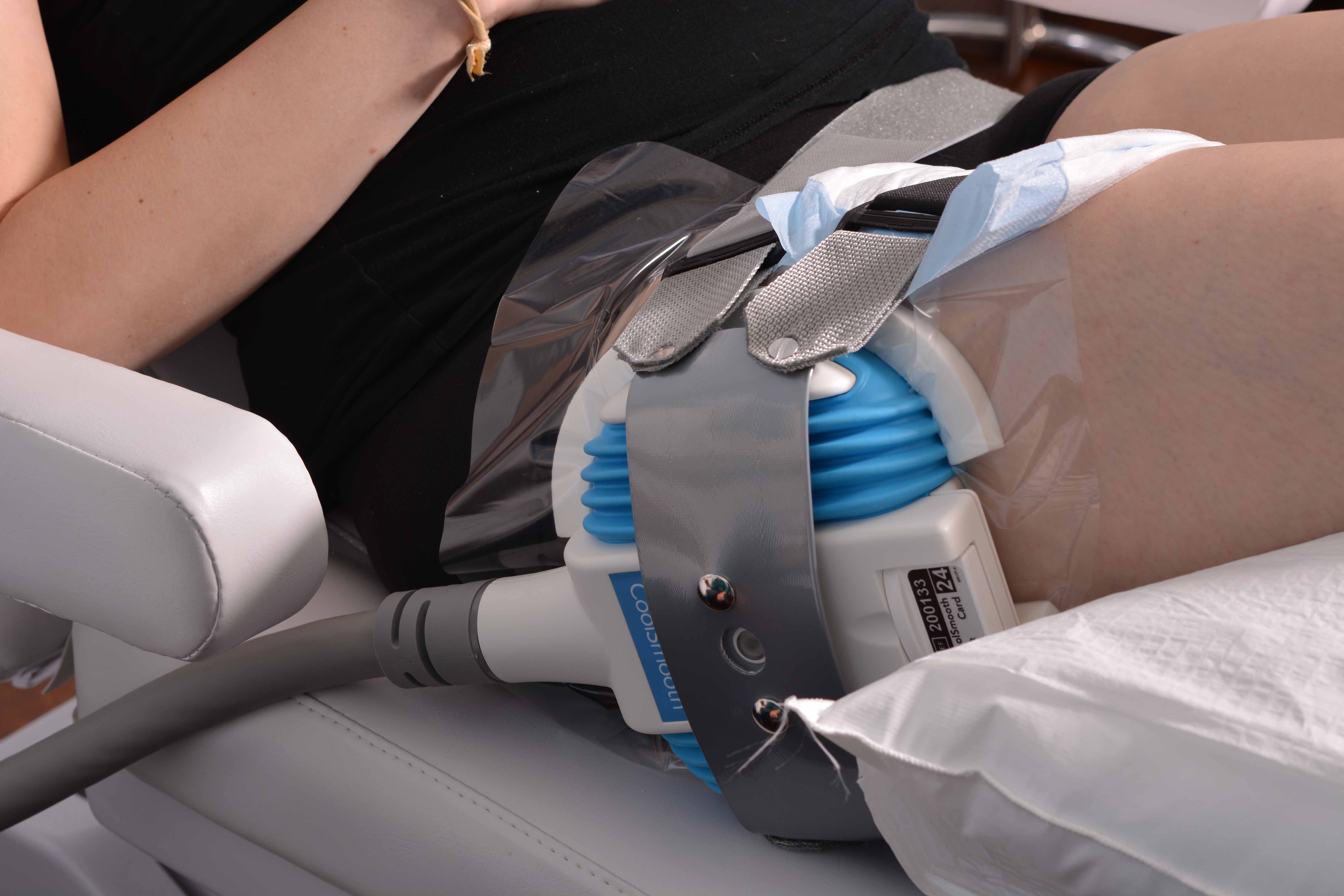 Meine Coolsculpting Erfahrung - das Fett am Oberschenkel soll weg! 